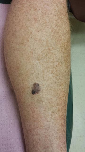 melanoma brown spots on legs